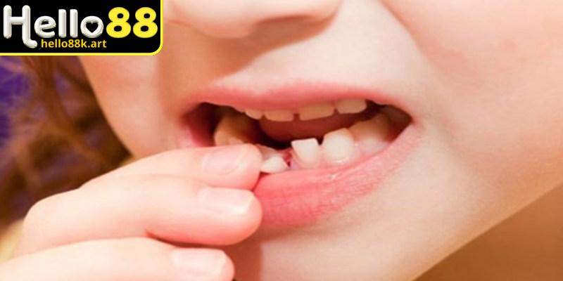 Giấc mơ mất răng trước thường liên quan đến sự tự ti hoặc lo lắng về ngoại hình